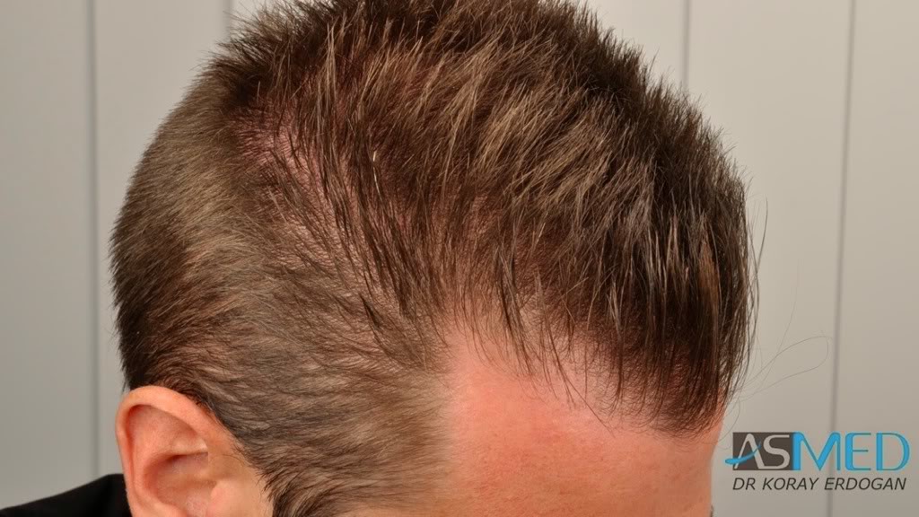 NORWOOD2 1113-grafts-FUE 0040f9e2