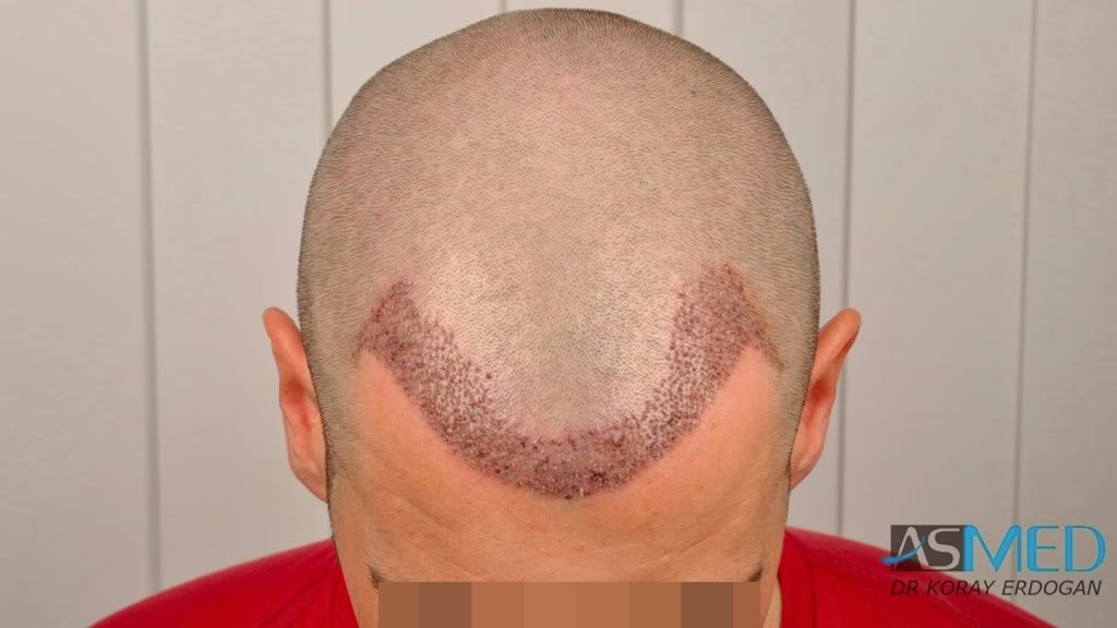NORWOOD2 1113-grafts-FUE 12333bf7