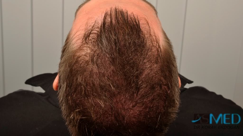 NORWOOD2 1113-grafts-FUE 36f0f051