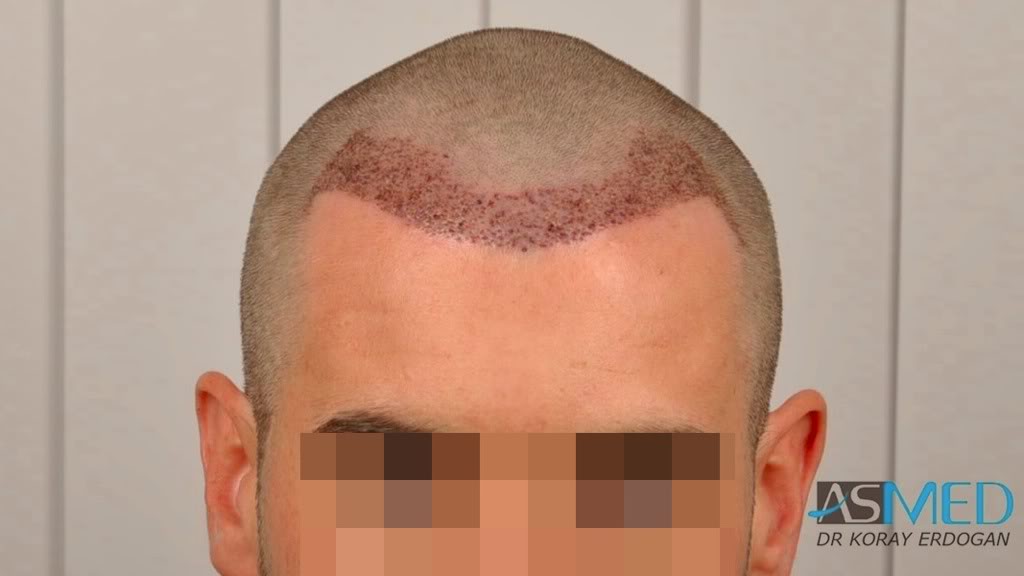 NORWOOD2 1113-grafts-FUE 379e477e