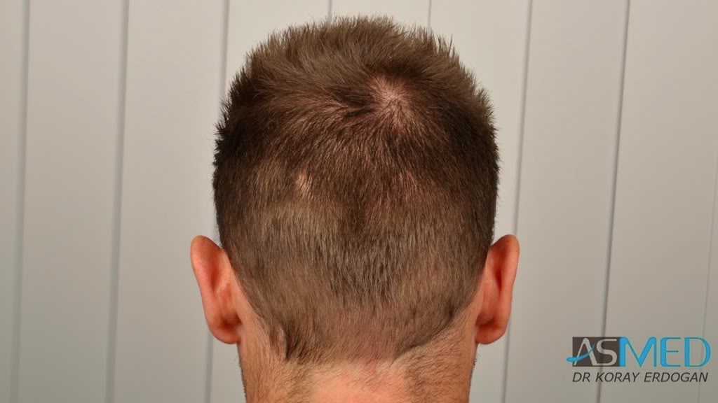 NORWOOD2 1113-grafts-FUE 7ca850b6