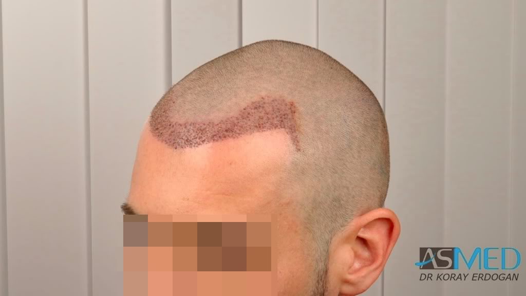 NORWOOD2 1113-grafts-FUE a7abee8b