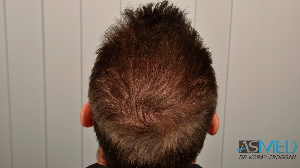 NORWOOD2 1113-grafts-FUE b0f3c291