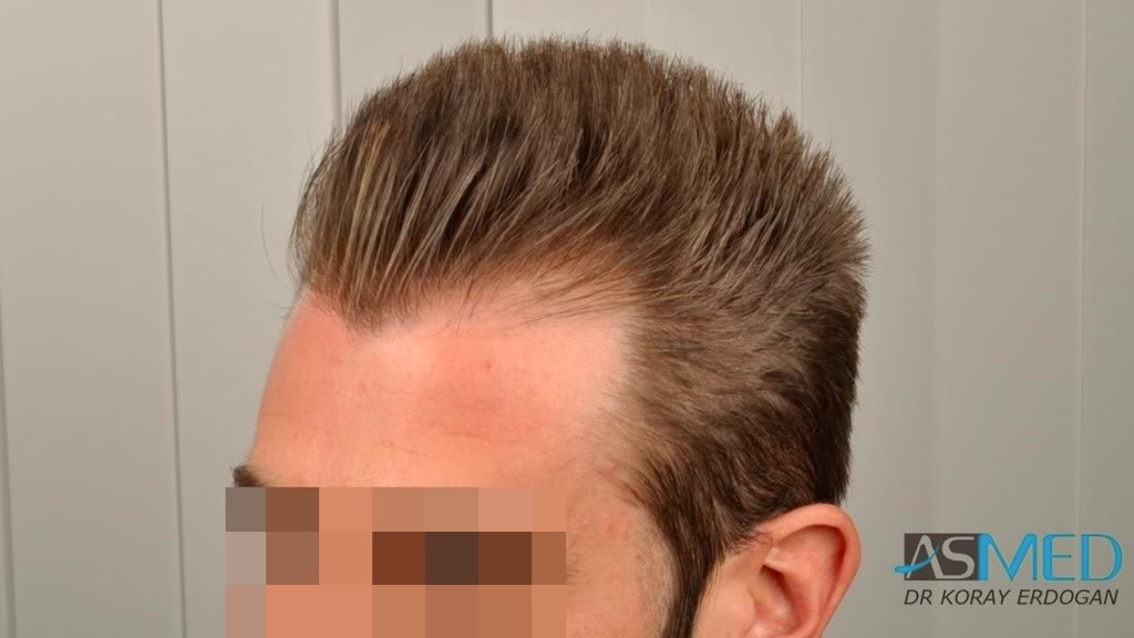 NORWOOD2 1113-grafts-FUE d78d2b4e