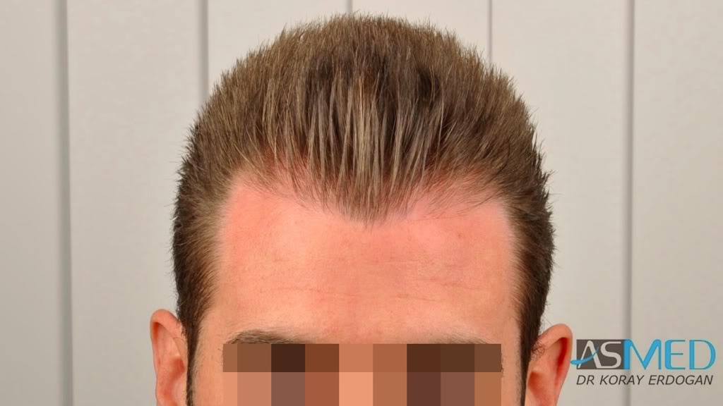 NORWOOD2 1113-grafts-FUE f5ae2a55
