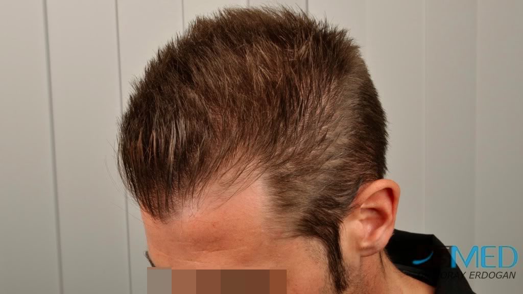 NORWOOD2 1113-grafts-FUE ffd6ee73