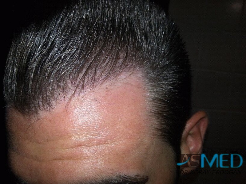 NORWOOD2 1113-grafts-FUE file-1