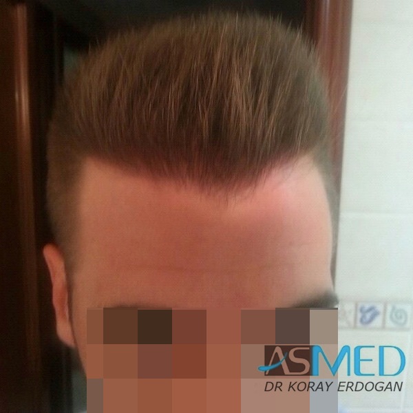 NORWOOD2 1113-grafts-FUE file-10