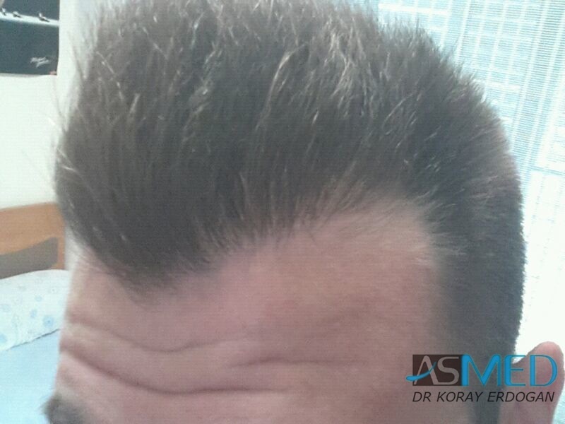 NORWOOD2 1113-grafts-FUE file-11