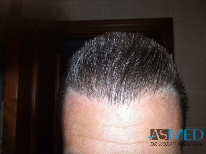 NORWOOD2 1113-grafts-FUE file-2