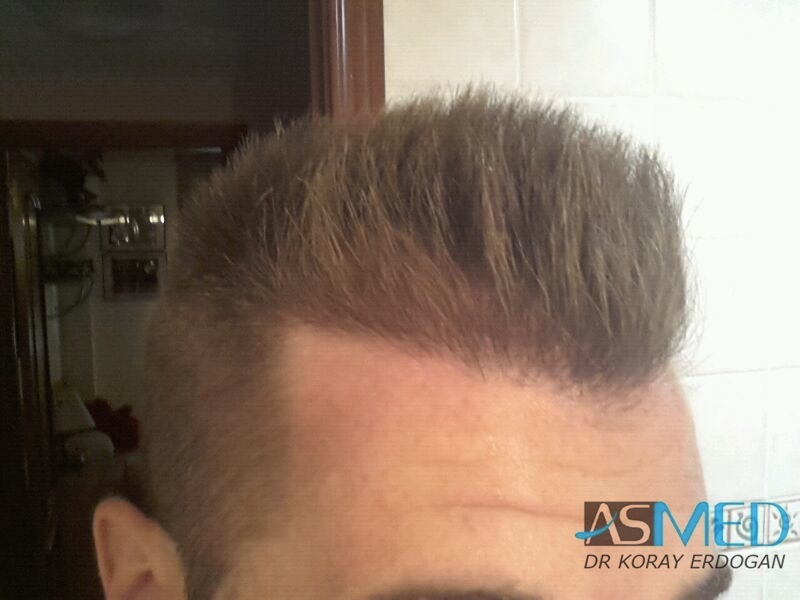 NORWOOD2 1113-grafts-FUE file-3