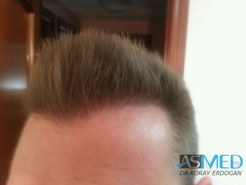 NORWOOD2 1113-grafts-FUE file-6