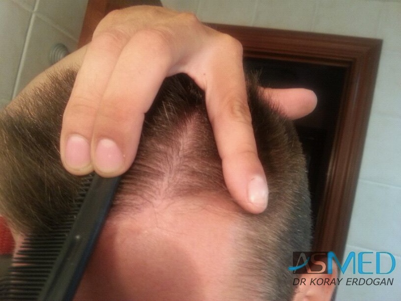 NORWOOD2 1113-grafts-FUE file-8