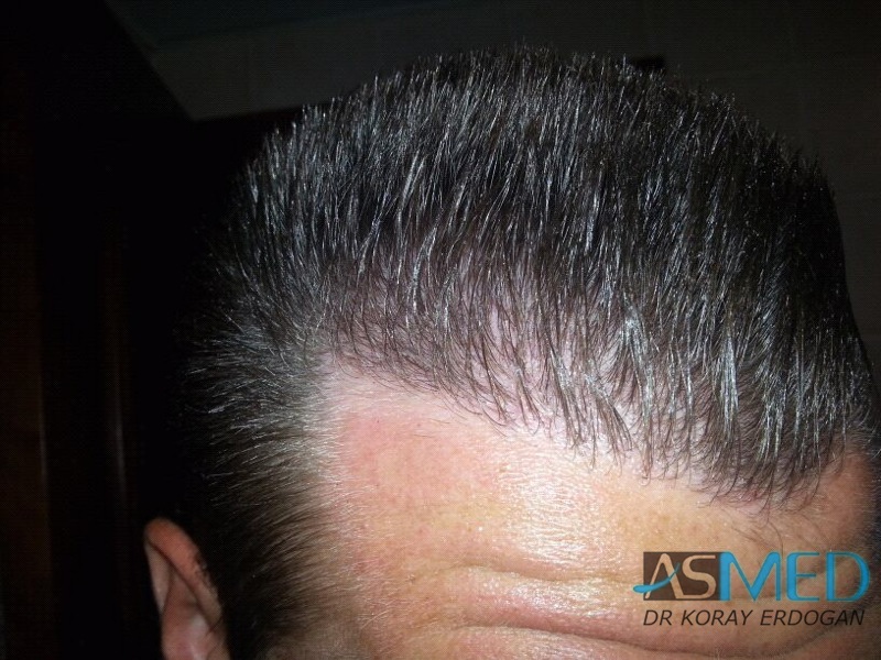 NORWOOD2 1113-grafts-FUE file