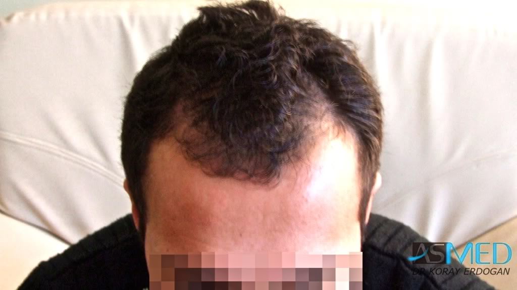NORWOOD2 1250-grafts-FUE 05491b62