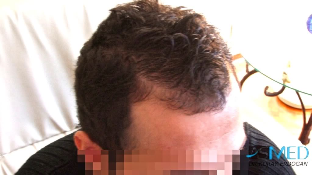 NORWOOD2 1250-grafts-FUE 0ae8588a