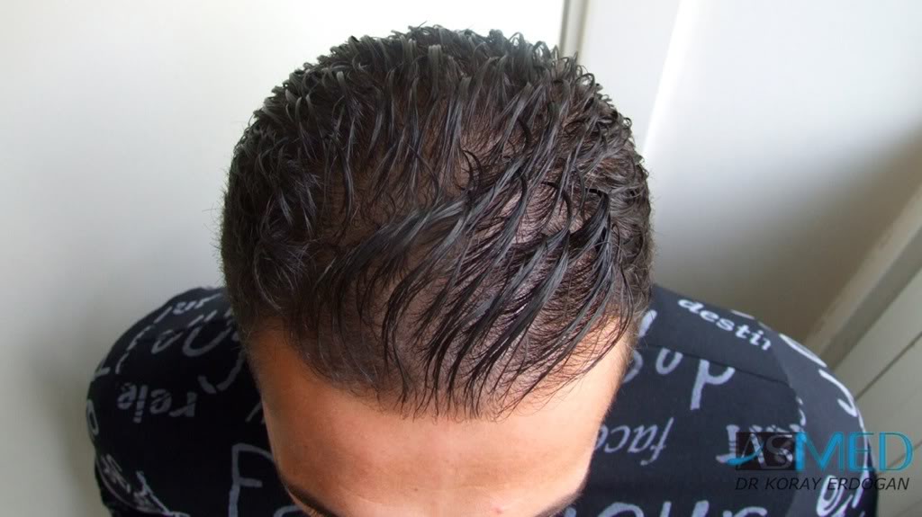 NORWOOD2 1250-grafts-FUE 2efcc967