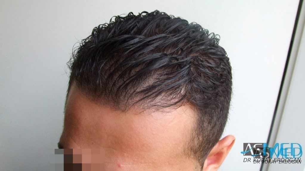 NORWOOD2 1250-grafts-FUE 606b1215
