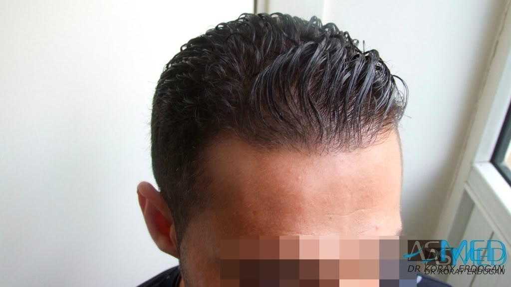 NORWOOD2 1250-grafts-FUE 782ad371