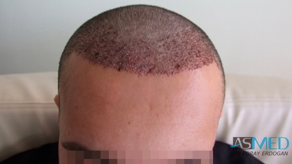 NORWOOD2 1250-grafts-FUE 951e300c