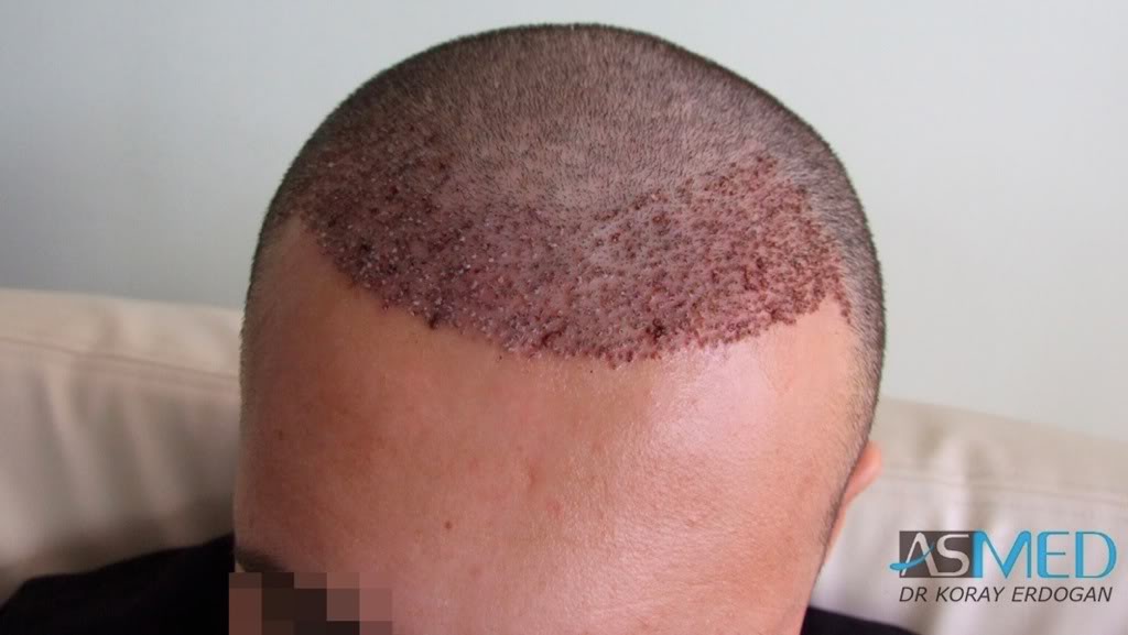 NORWOOD2 1250-grafts-FUE 9cd5646f
