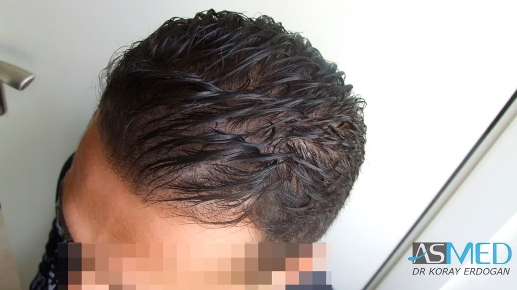 NORWOOD2 1250-grafts-FUE adcfb051