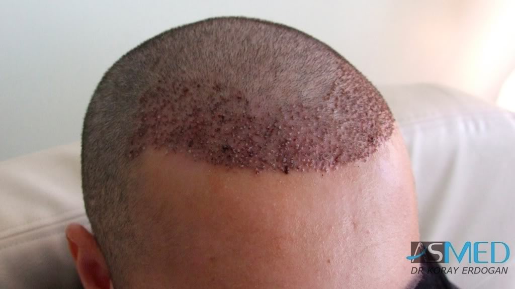 NORWOOD2 1250-grafts-FUE b326c4ef