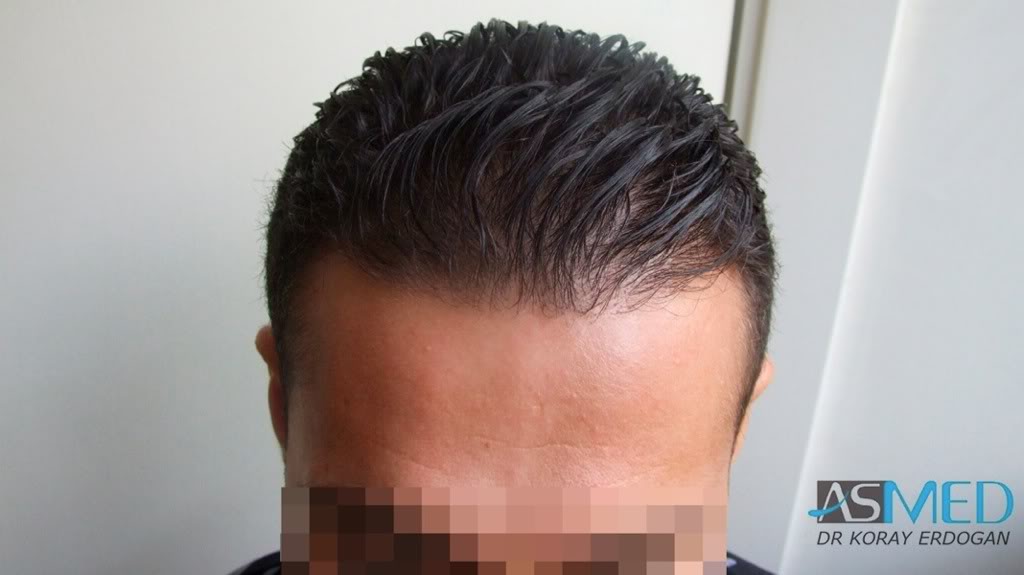 NORWOOD2 1250-grafts-FUE d1577d2a