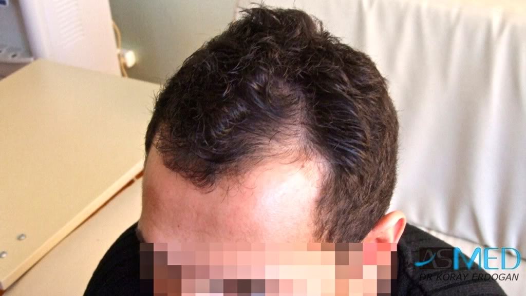 NORWOOD2 1250-grafts-FUE d7758ad3