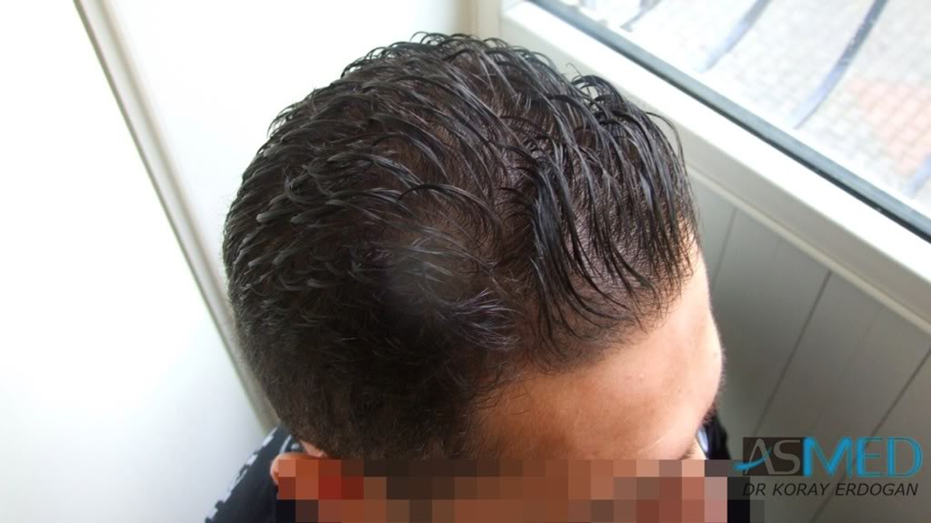 NORWOOD2 1250-grafts-FUE e13a3013