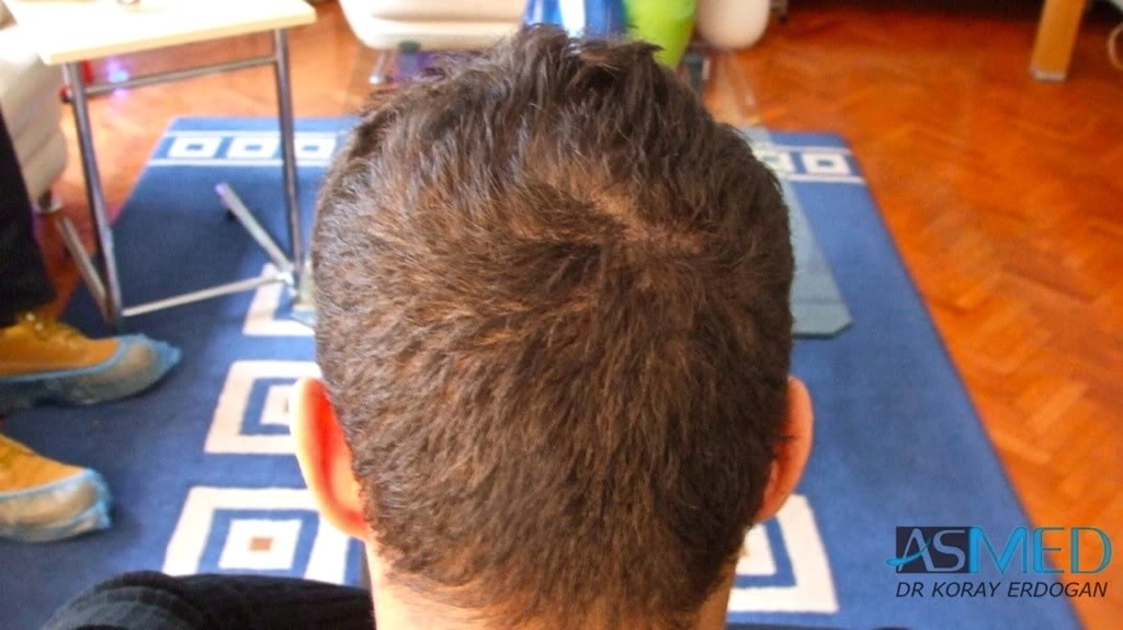 NORWOOD2 1250-grafts-FUE f2480025