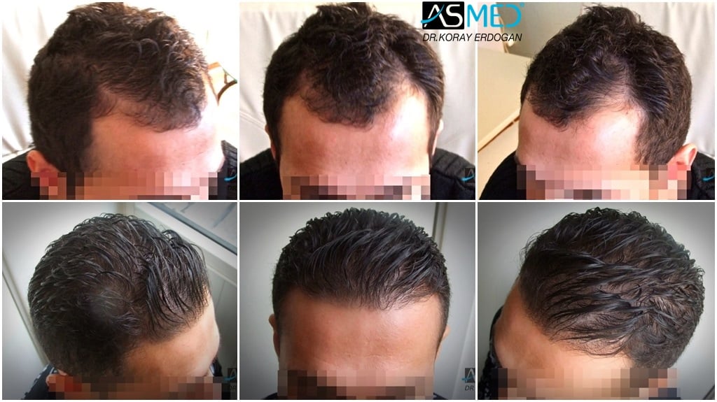 1250-grafts-FUE