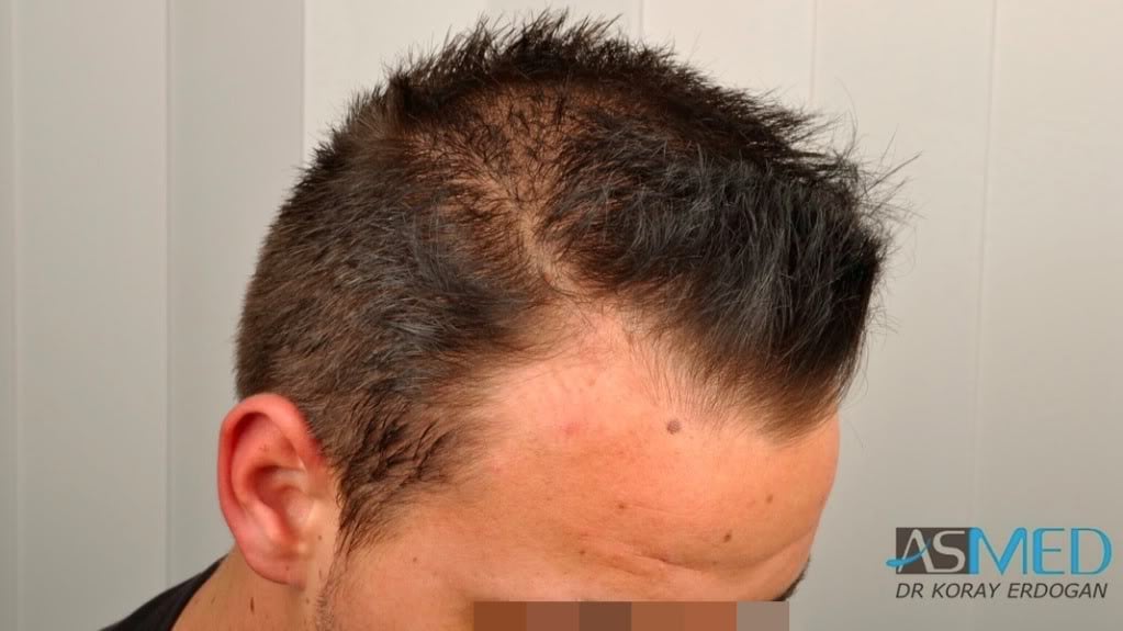 NORWOOD2 1500-grafts-FUE file-1