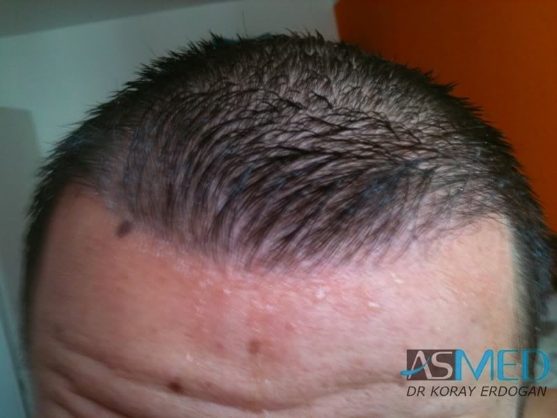 NORWOOD2 1500-grafts-FUE file-11