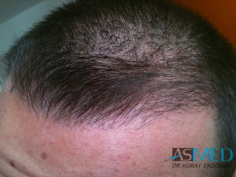 NORWOOD2 1500-grafts-FUE file-12