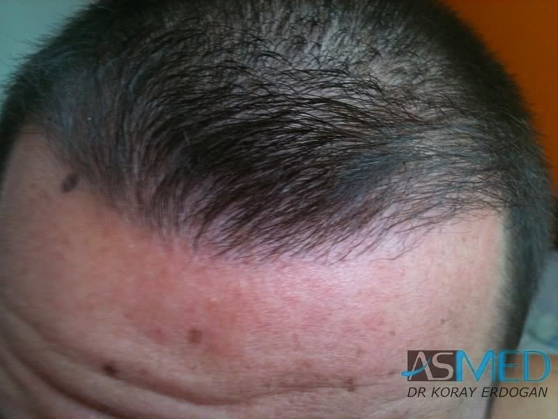 NORWOOD2 1500-grafts-FUE file-13