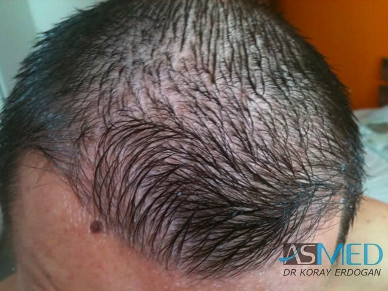NORWOOD2 1500-grafts-FUE file-14