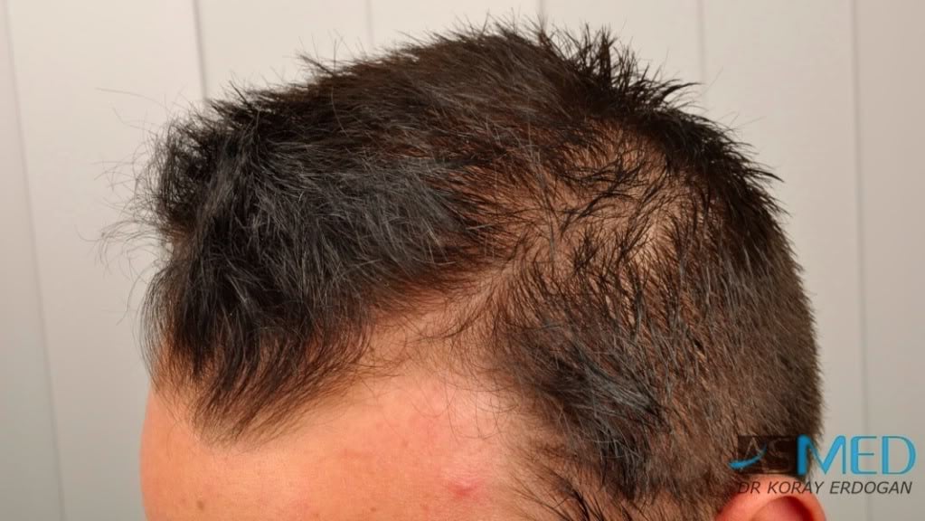 NORWOOD2 1500-grafts-FUE file-2