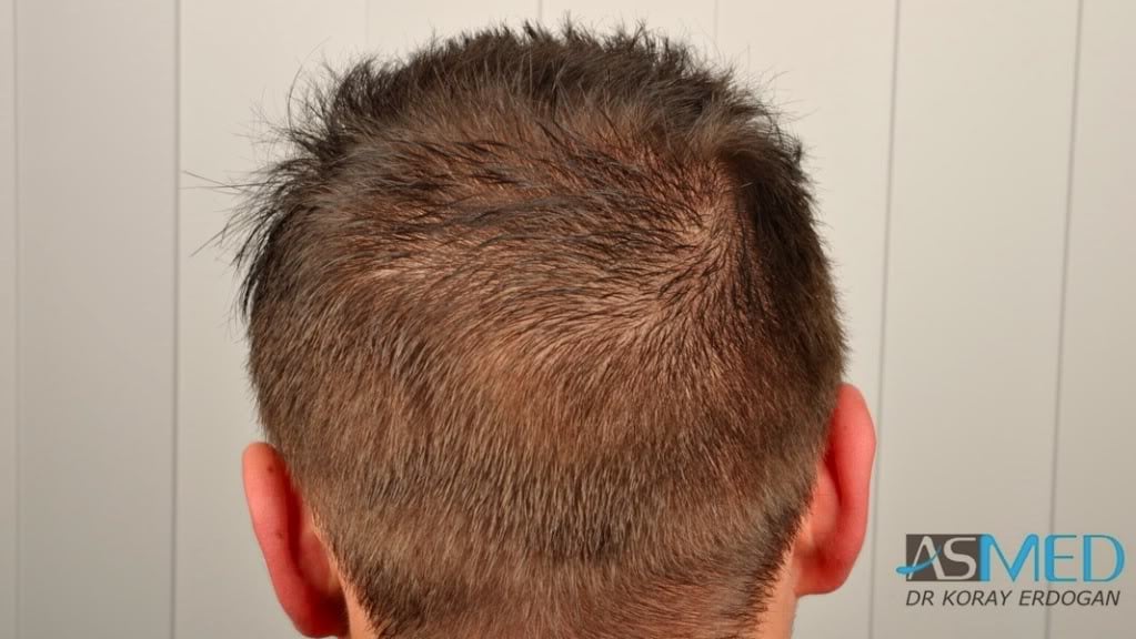 NORWOOD2 1500-grafts-FUE file-3