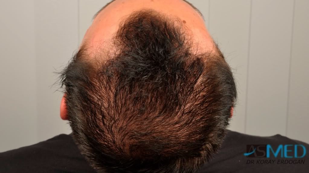 NORWOOD2 1500-grafts-FUE file-4