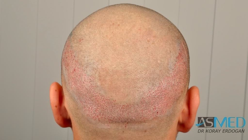 NORWOOD2 1500-grafts-FUE file-8