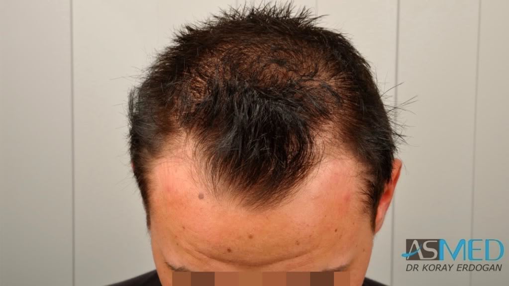 NORWOOD2 1500-grafts-FUE file
