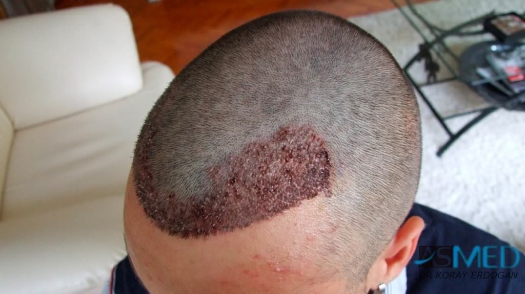 NORWOOD2 1800-grafts-FUE-2 3c08ccf4