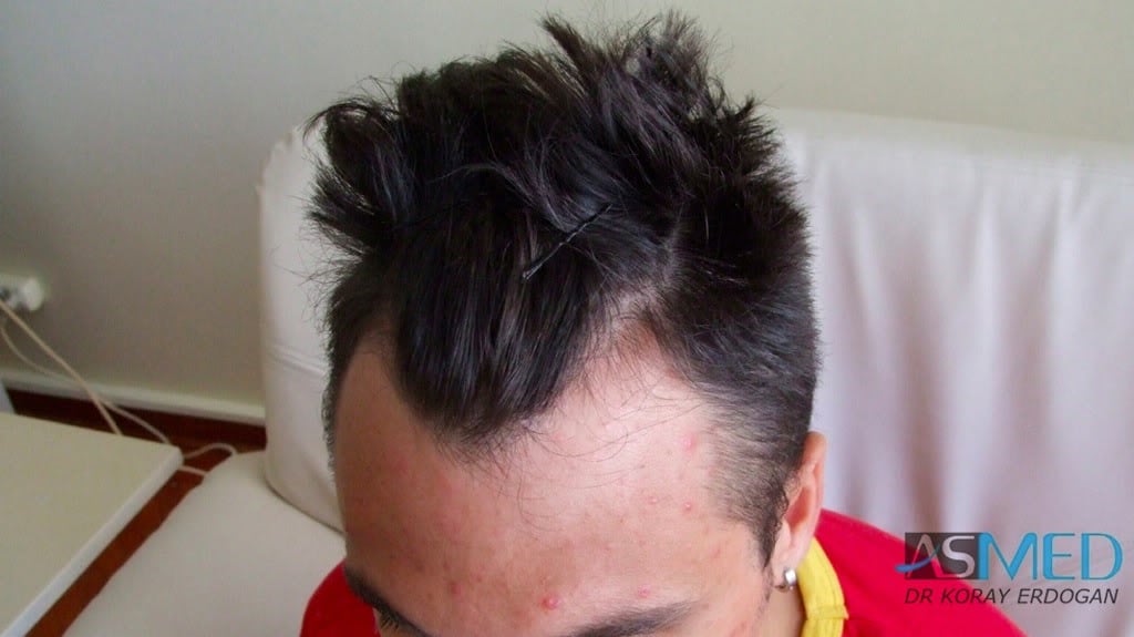 NORWOOD2 1800-grafts-FUE-2 42c96fe2