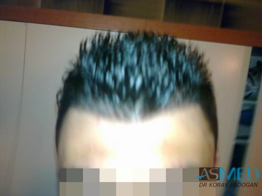 NORWOOD2 1800-grafts-FUE-2 7211d182