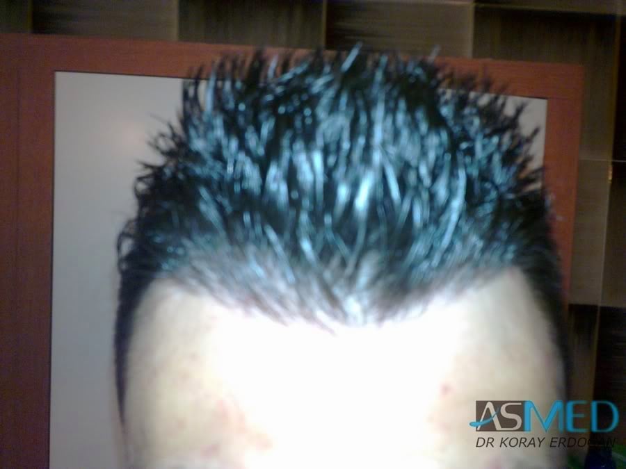 NORWOOD2 1800-grafts-FUE-2 76ccf080