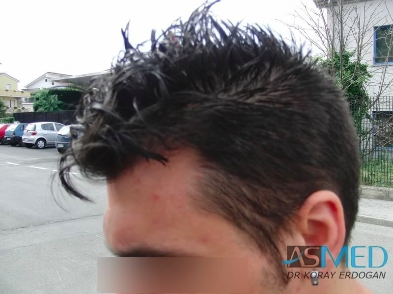 NORWOOD2 1800-grafts-FUE-2 8ad32cf8