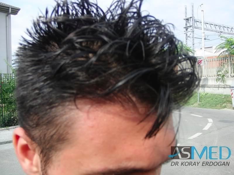 NORWOOD2 1800-grafts-FUE-2 a8128778