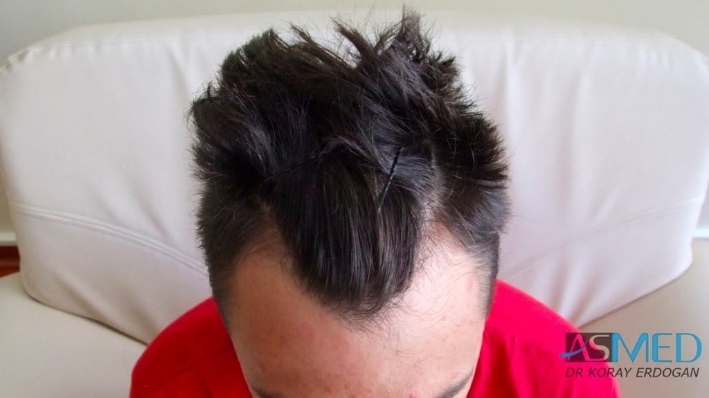 NORWOOD2 1800-grafts-FUE-2 abf31463