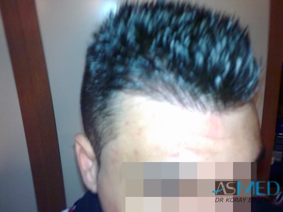 NORWOOD2 1800-grafts-FUE-2 ada1db0f